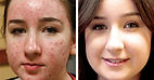 Acne Treatment Cape Town with the BBL Hero Aesthetics Laser Machine near me and the best