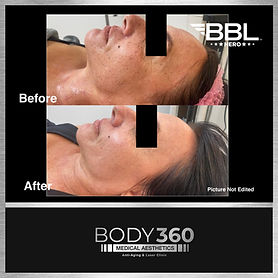 bbl before after pigmentation.jpg