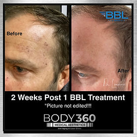 bbl hero cape town pigmentation .jpg