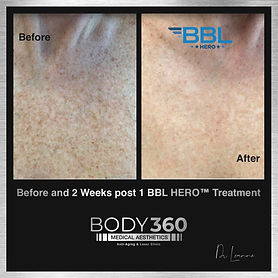 bbl hero cape town pigmentation treatment cape town melkbosstrand.jpg