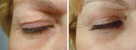 The Plexr before & after eye lift best cape town