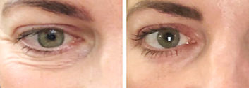 body360 Aesthetics eye wrinkles 2.jpg
