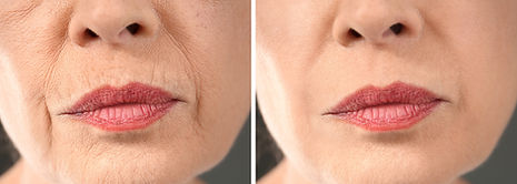 body360 Aesthetics take away smokers lip before & after of the plexr cape town