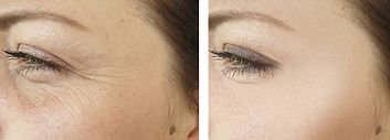 body360 Aesthetics take away wrinkles ca
