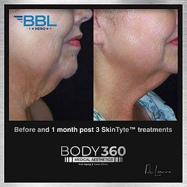 Body360 medical aesthetics anti-aging & laser clinic cape town bbl hero.jpg