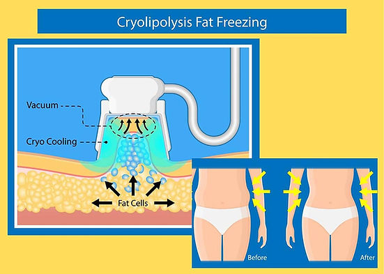cryolipolysis-fat-freezing-explained.jpg