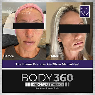 The Elaine Brennan GetGlowing Micro-Peel Before and After