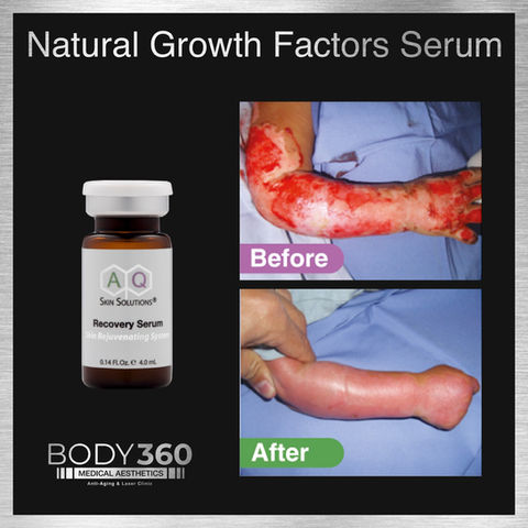 burnt skin treatment highest concentration of natural growth factors Serum AQ Skin Solutio