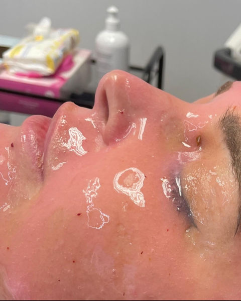Dermaplaning Cape Town