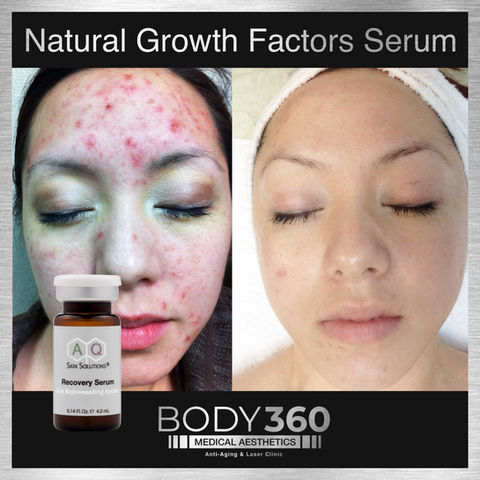Acne Treatment highest concentration of natural growth factors Serum AQ Skin Solution’s Sk