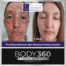 Elaine Brennan Renewal Peel Body 360 Before and After