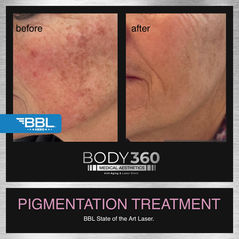 pigmentation treatment bbl hero laser cape town .jpg