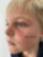 body 360 medical aesthetics Spider angioma treatment with thw bbl hero cape town.jpg