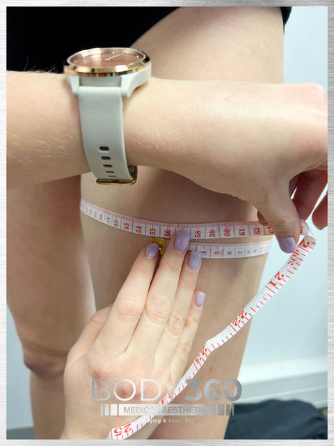 Fat Freezing and Body Contouring mesuring