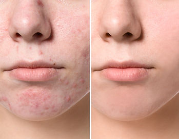 face acne treatment teen .jpg