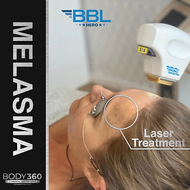 melasma treatment laser cape town pigmentation.jpg
