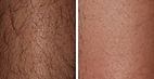 forever bare bbl hero best permanent hair removal laser in cape town near me