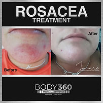 rosacea treatment treatment cape town doctor aesthetics clinic near me.jpg