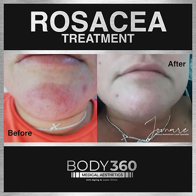 rosacea treatment cape town doctor aesthetics clinic
