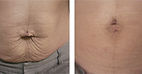 Skintyte Before & After BBL Hero The Best Skin Tightening Treatment Cape Town