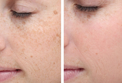 SkinTyte_4_before_bbl hero cape town melkbosstrand laser.jpg