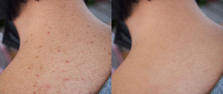 teen acne treatment cape town face and back.jpg