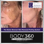 The Elaine Brennan Skin Renewal Peeling System Cape Town Before and After