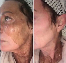 The Elaine Brennan Skin Renewal Peeling System body 360 medical aesthetics cape town befor