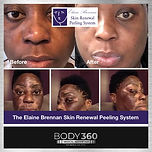 The Elaine Brennan Skin Renewal Peeling System Cape Town
