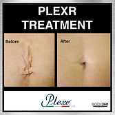 the plexr cape town aesthetics fixing the belly button.jpg