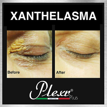 xanthelasma treatment Plexr cape town doctor near me best aesthetics .jpg