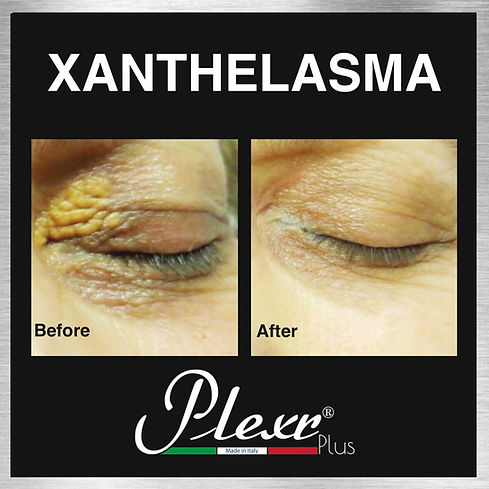 xanthelasma treatment Plexr cape town doctor near me best aesthetics .jpg