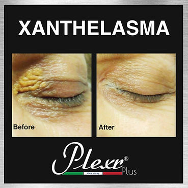 xanthelasma treatment Plexr cape town doctor near me best aesthetics .jpg